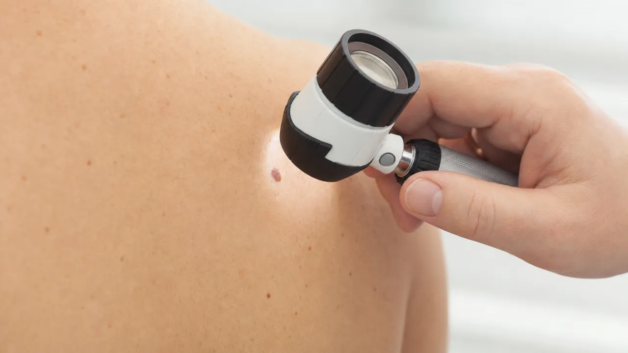 Map My Mole at Carlton Pharmacy